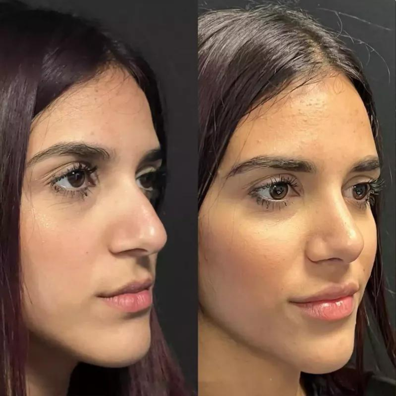 Global Rhinoplasty Consults: Explore Your Options Anywhere