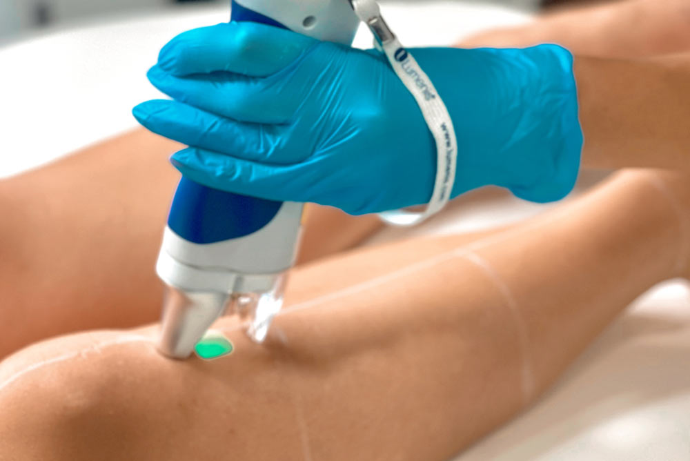 Hair Removal Bournemouth: Achieve Smooth Skin with Skin Zest
