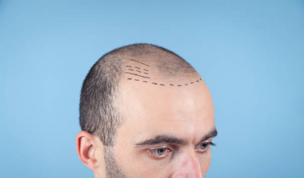 Hair Transplant in Karachi and Laser Hair Removal