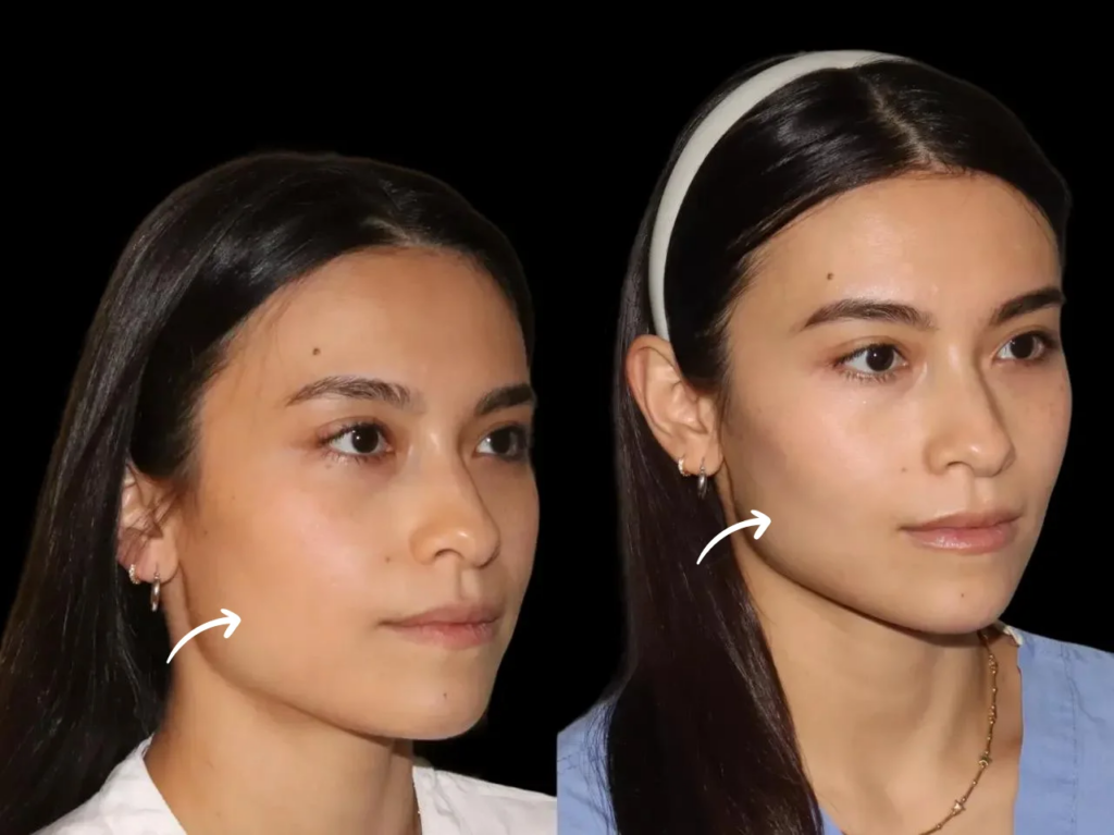 Sculptra: The Long-Lasting Filler Option at the Best Aesthet