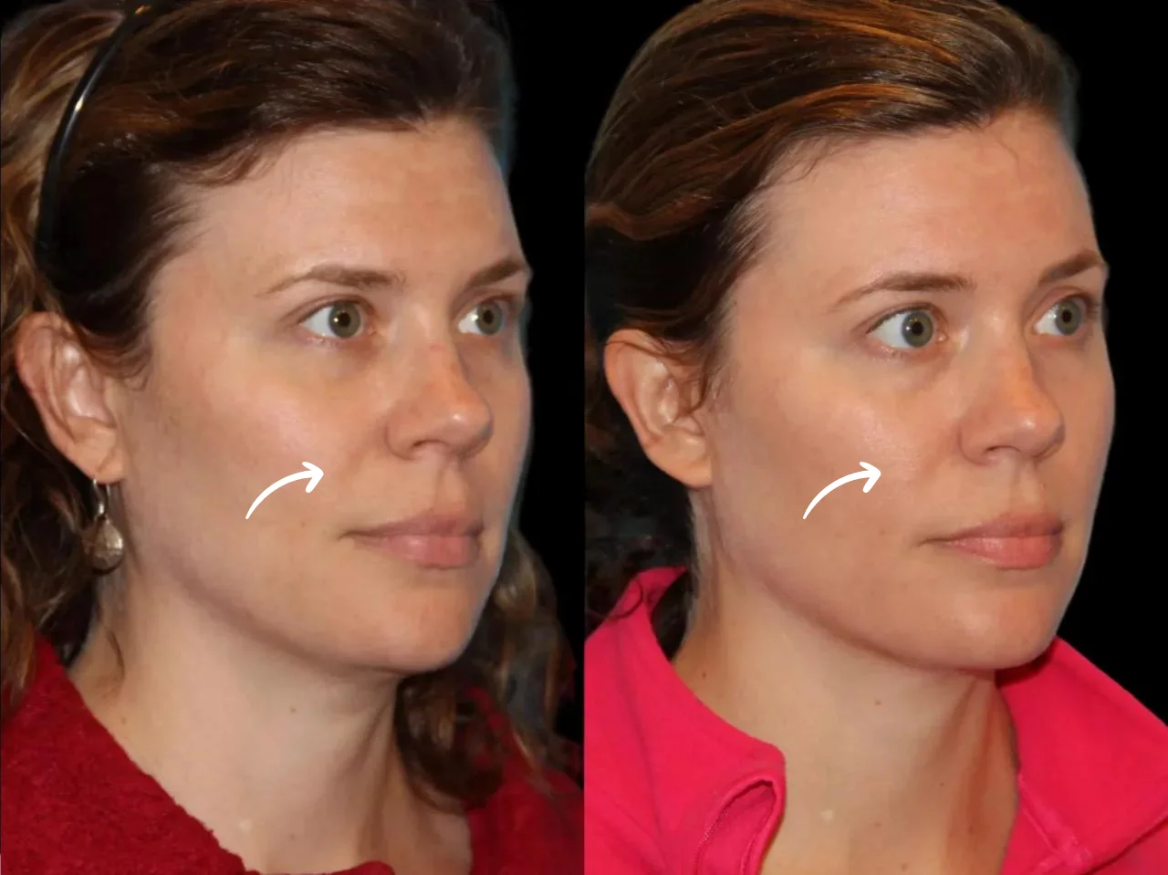 How Sculptra Fillers in Dubai Can Turn Back the Clock