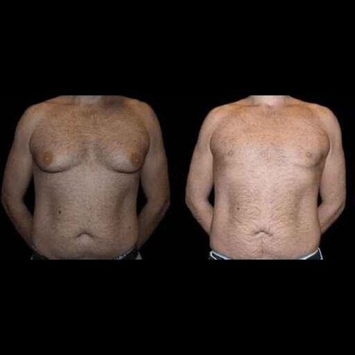 Right Clinic and Surgeon for Best Gynecomastia in Dubai