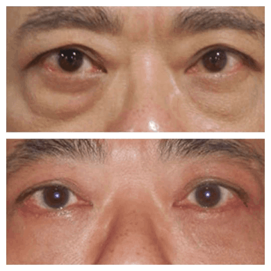 Can Eye Bag Removal Be Combined with Other Procedures? Insights from the Best Doctors in Dubai