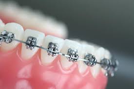 Global Orthodontics Market Analysis Size And Forecast Report