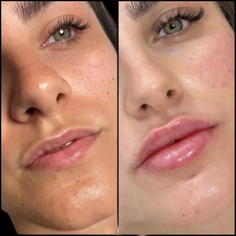 How Juvederm treatment in Dubai Stands Out in the Global Market