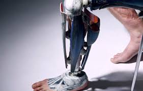 Orthopedic Prosthetics Market Analysis Size And Forecast Rep