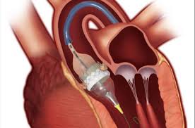 Transcatheter Heart Valve Replacement Market Analysis Size A