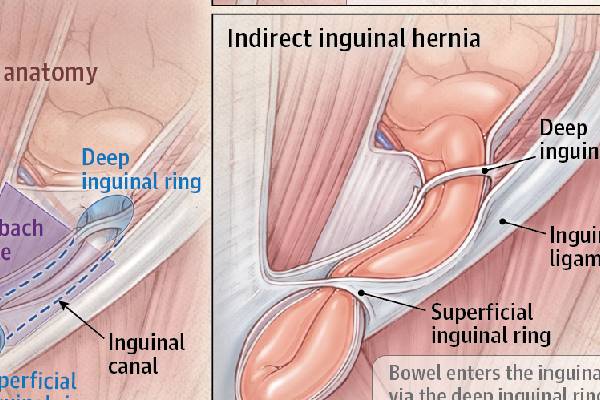 Understanding Robotic Inguinal Hernia Repair