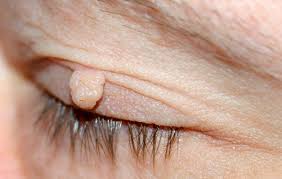 Which Areas of the Eyelid Are Most Prone to Skin Tags?