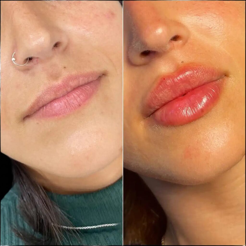 Best Aesthetic Clinics in Dubai for Perfect Lip Symmetry
