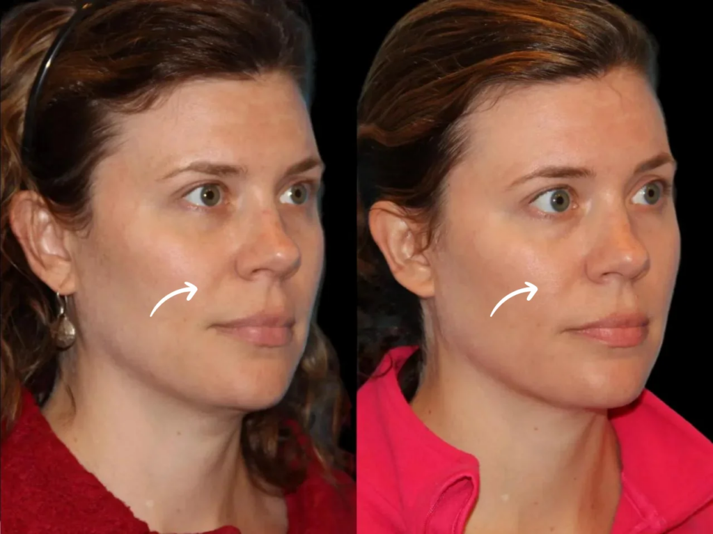 How Best Doctors in dubai Use Sculptra for Anti-Aging