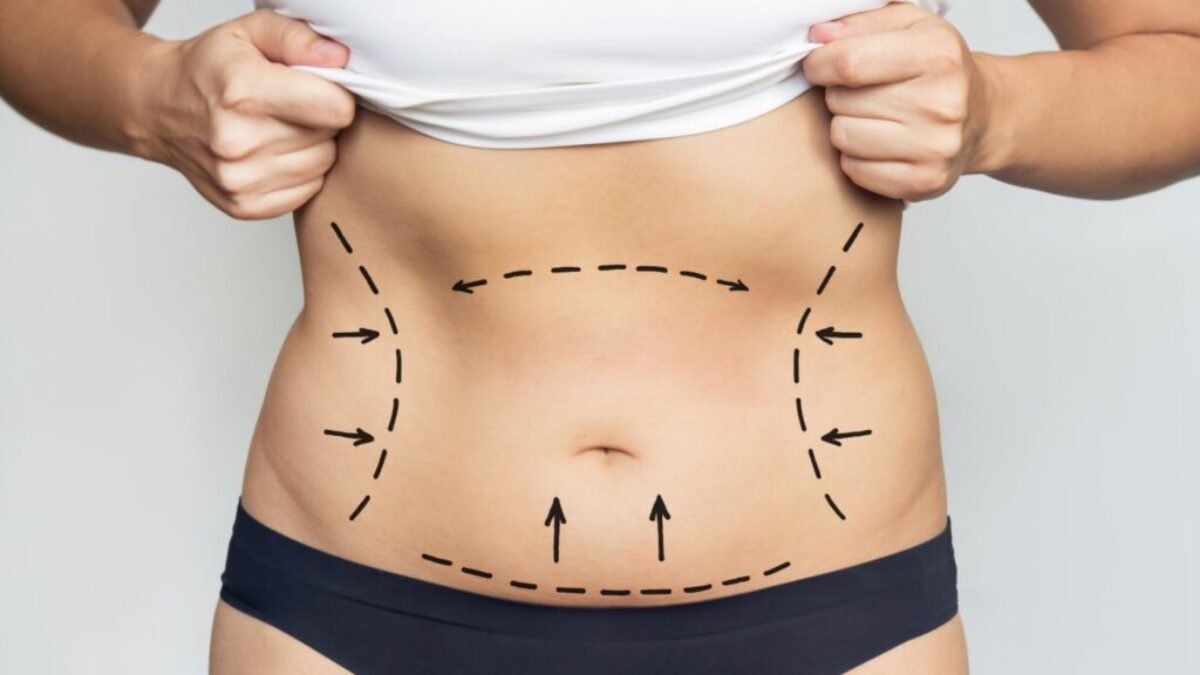 Full Body Liposuction Surgery Impact From Best Liposuction Surgeon in Dubai