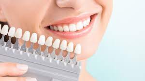 Essential Maintenance Tips for Your Dental Veneers Care