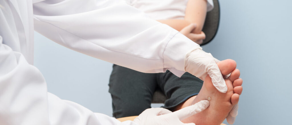 Wart Removal Pricing: What Are the Options?