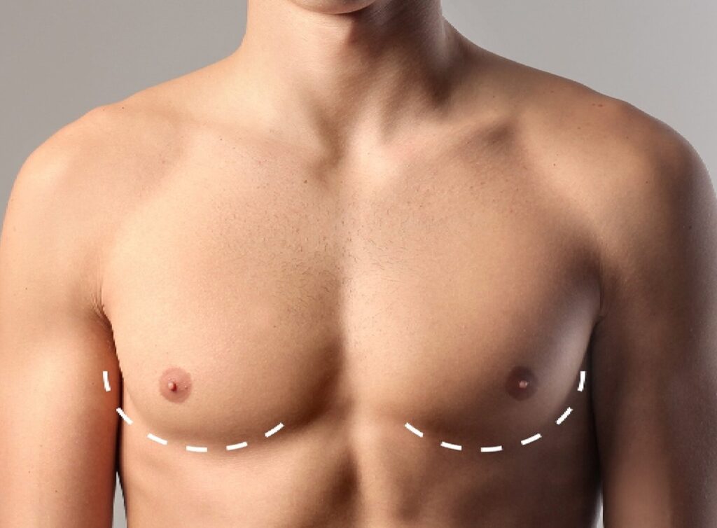Questions to Ask Before Gynecomastia Surgery in dubai