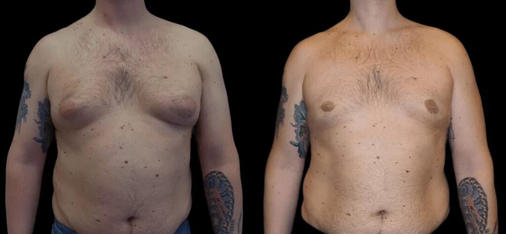 The Ultimate Guide to Gynecomastia Surgery Cost in dubai