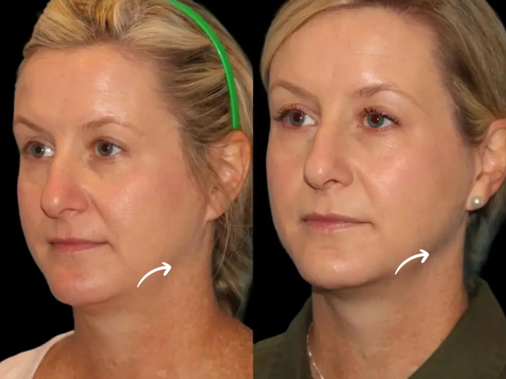 Are Sculptra Fillers in Dubai Safe for All Skin Types?