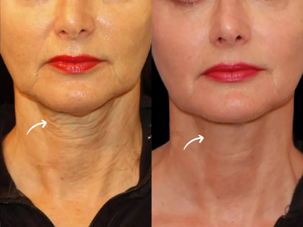 Best Doctors in dubai Share Sculptra Success Stories