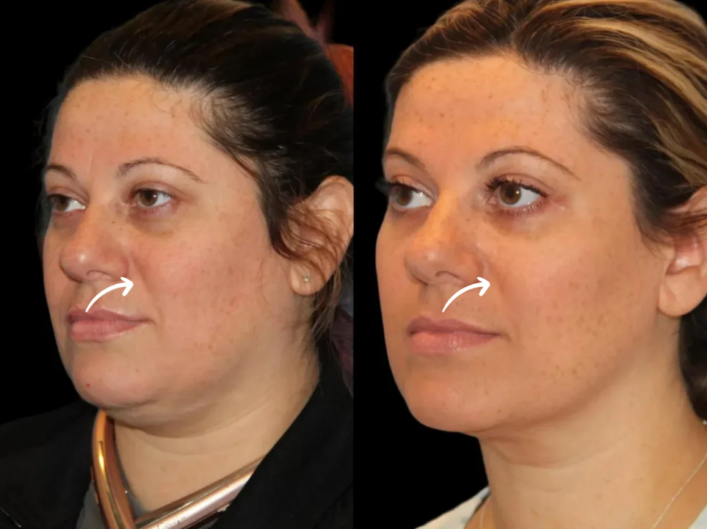 Why Residents Choose Sculptra Fillers Treatment in dubai