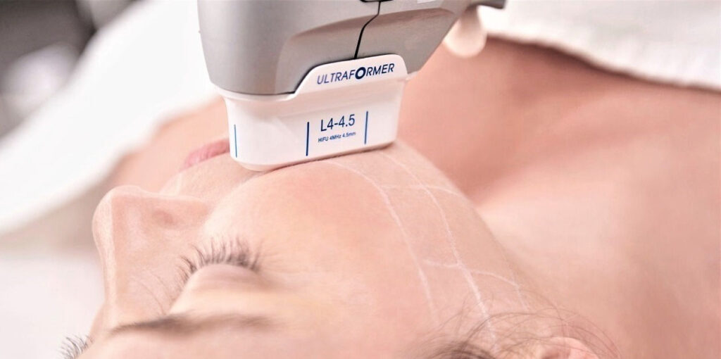 HIFU Treatment: The Secret to Youthful Skin Without Surgery