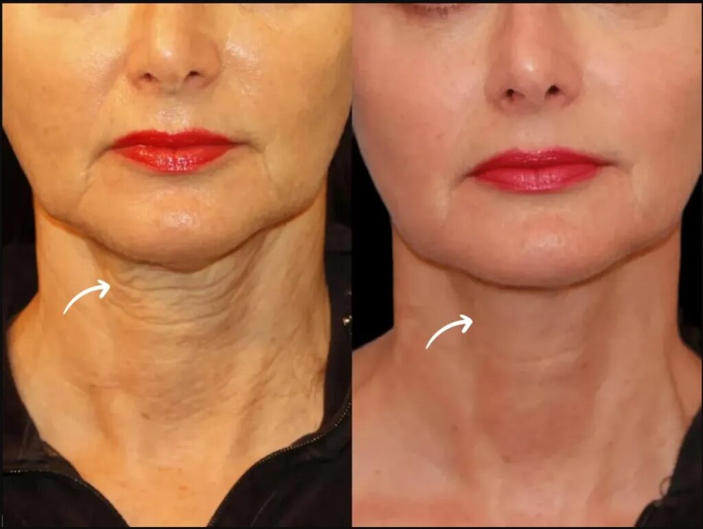 How Sculptra Works: A Guide from the Best Doctors in dubai