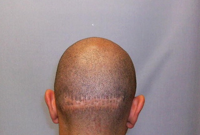 What Influences the Price of a Hair Transplant?