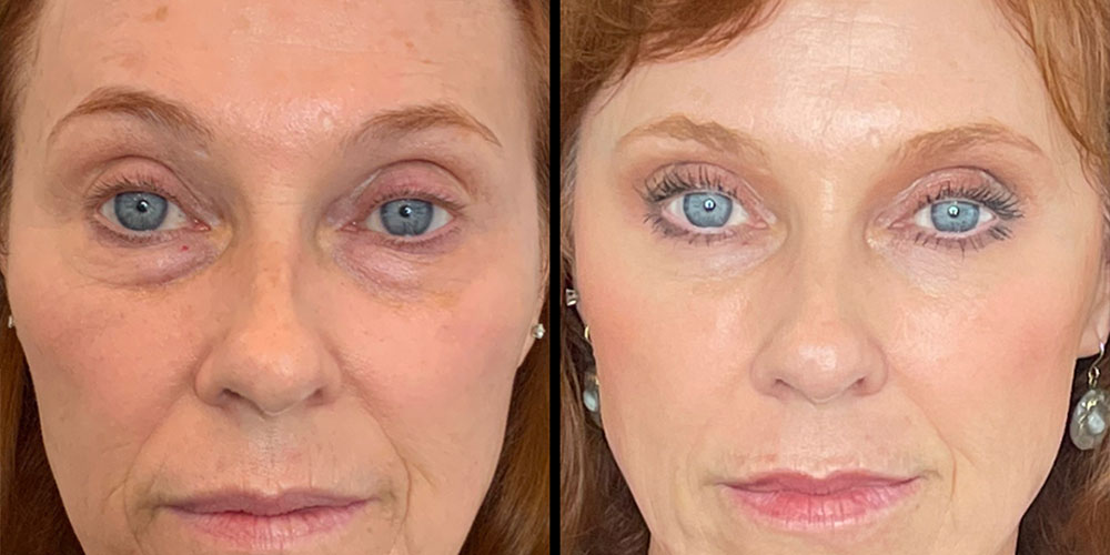 Morpheus8 Dubai: The Best Treatment for Skin Tightening