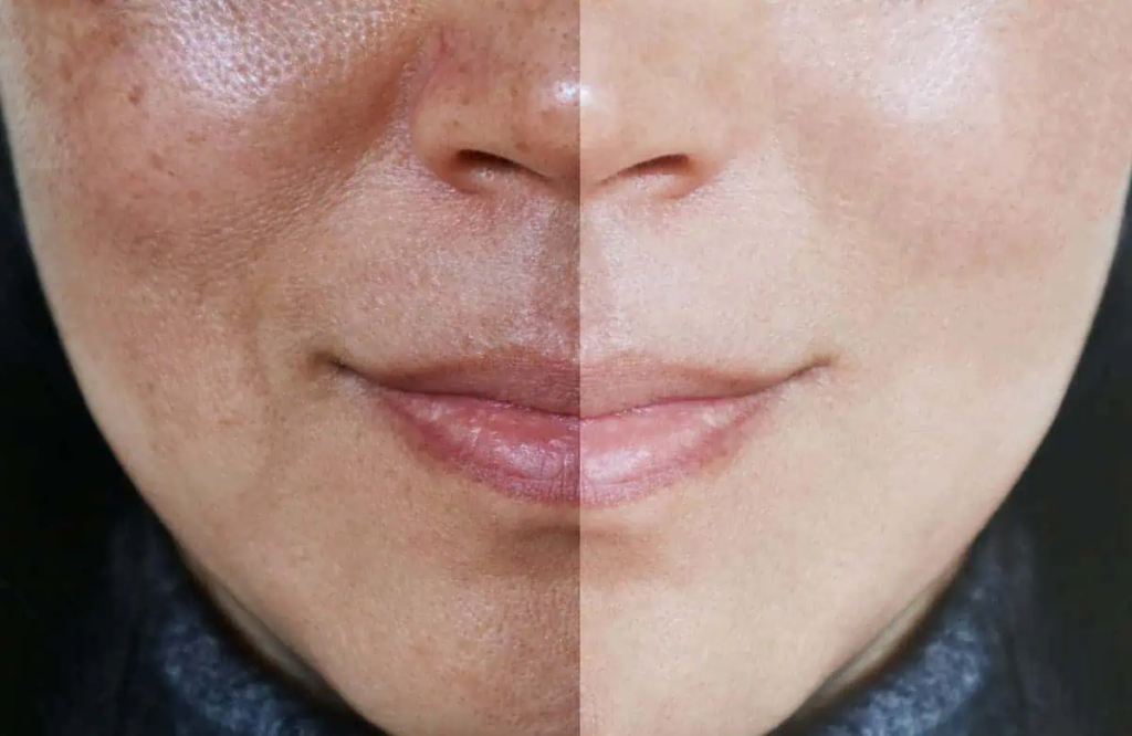 Pico Laser Treatment: Is It the Right Choice for You?