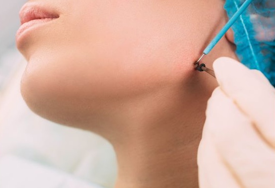 How to Remove Skin Tags with Minimal Effort