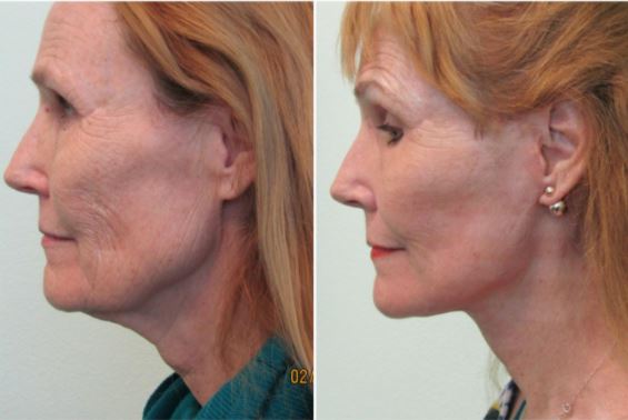Fractional CO2 Laser for Skin Discoloration: Effective and G