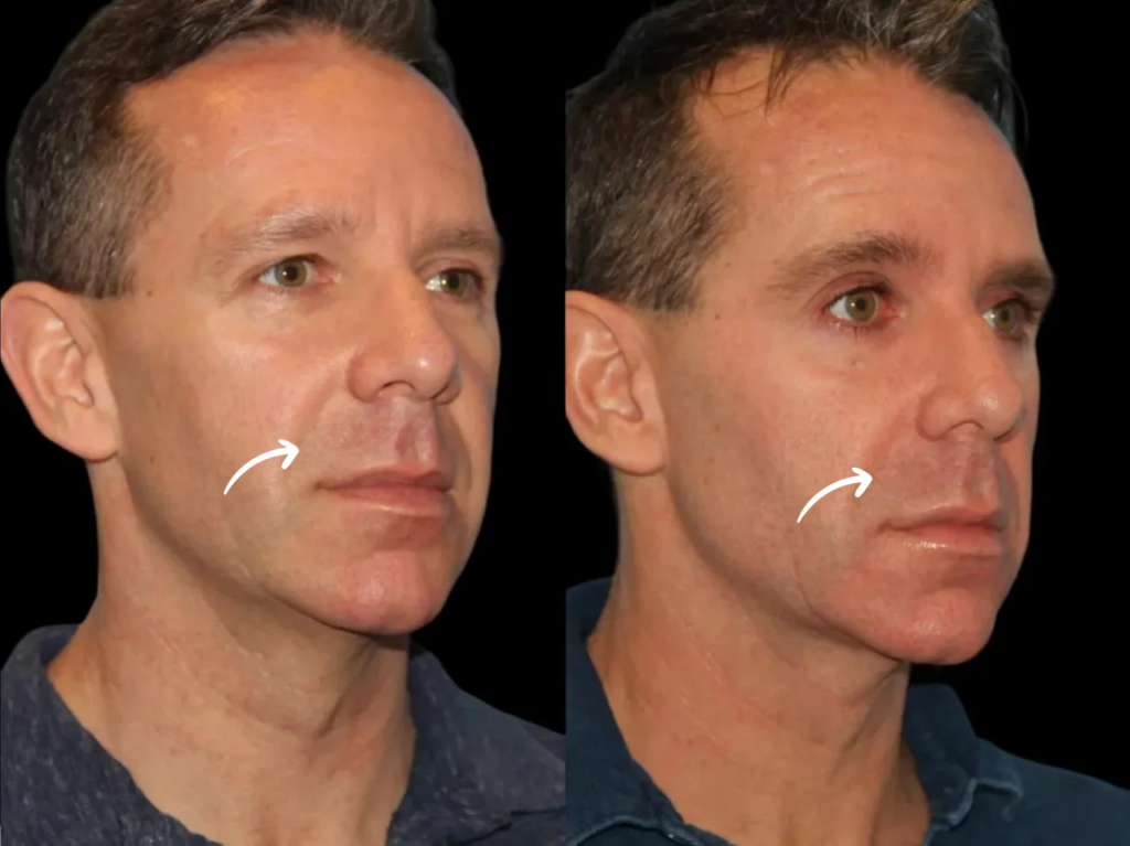 How Safe Are Sculptra Fillers Treatments in Dubai?