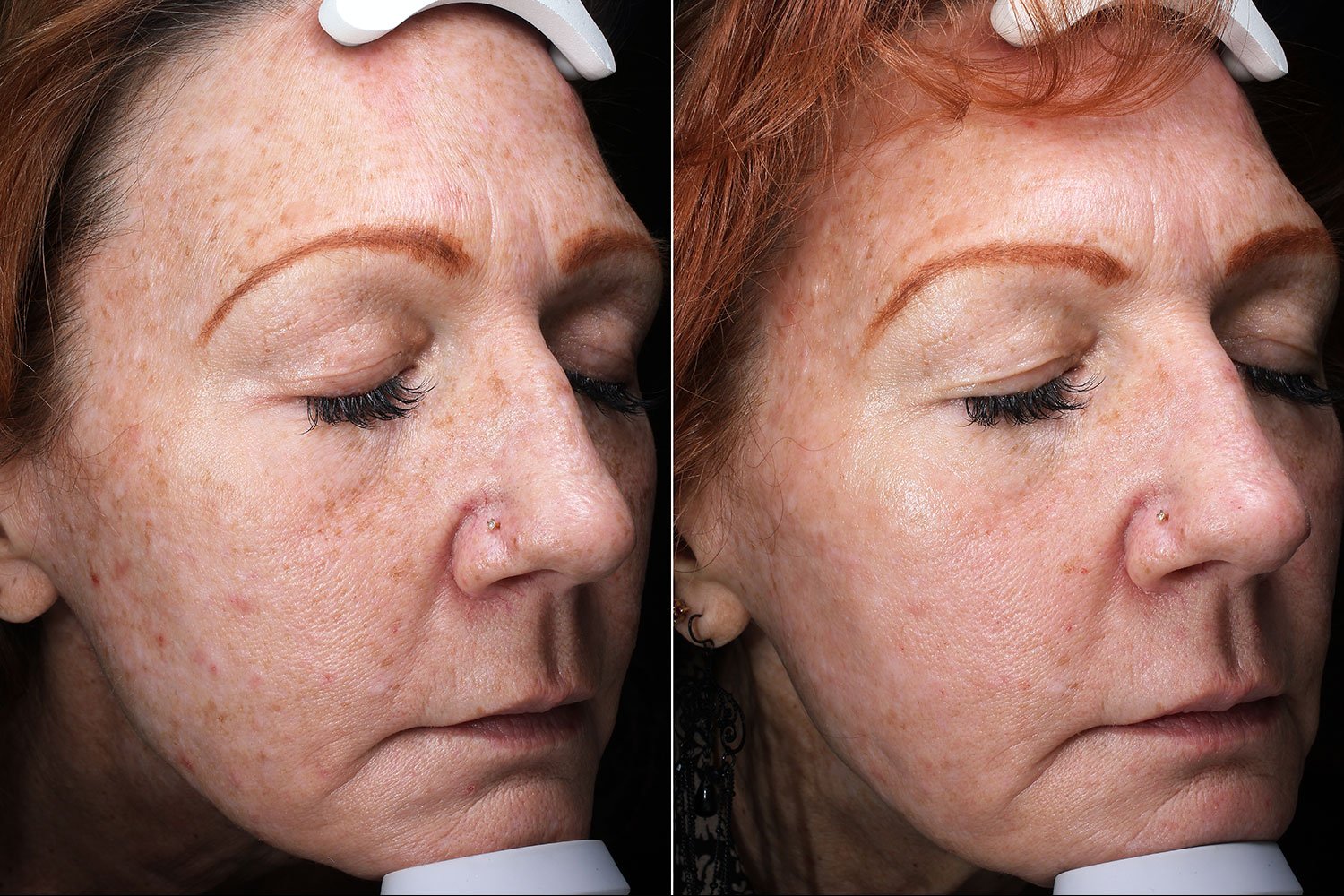 Fractional CO2 Laser is a Top Choice for Skin Resurfacing