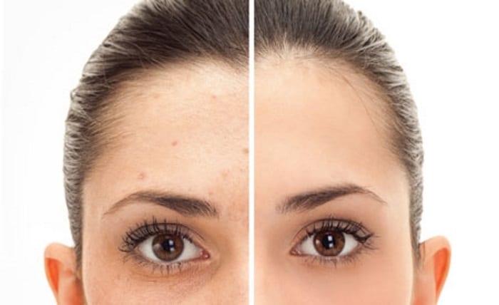 Transform Your Skin in Just a Few Sessions with Pico Laser