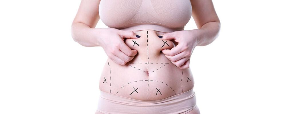 Understanding Liposuction: A Comprehensive Guide to Fat Loss
