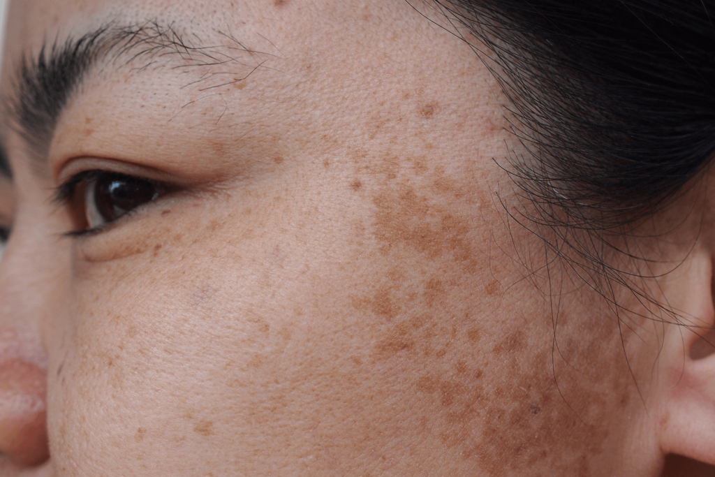 Melasma Guide: Find the Right Treatment for Your Skin Type