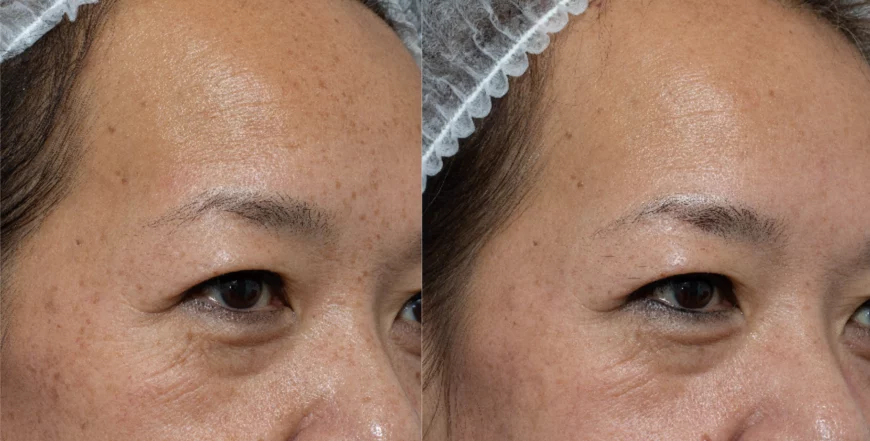 How Does Pico Laser Treatment Help with Sun Spots and Age Sp