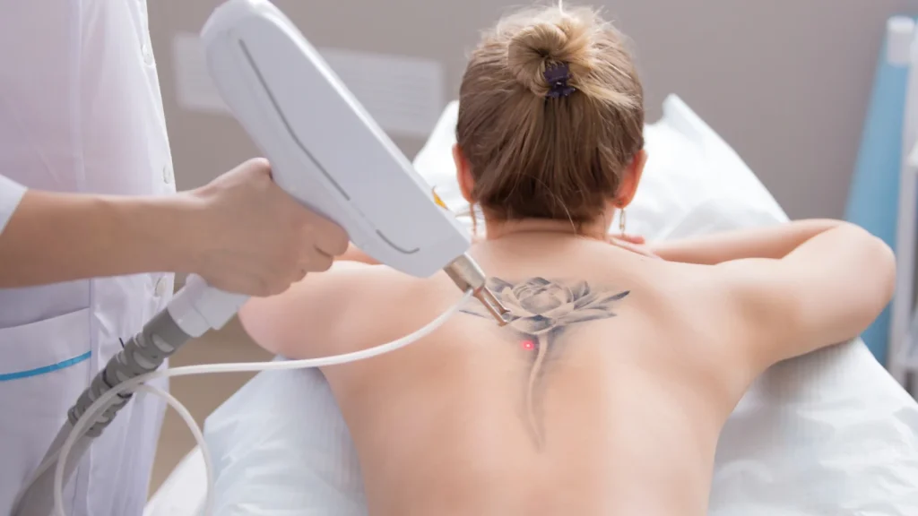 Pico Laser Technology: Achieve Clear Skin by Removing Tattoo