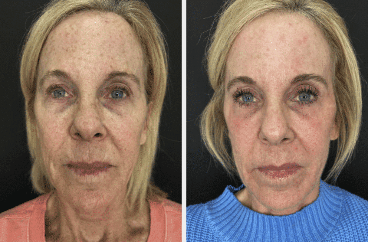 Fractional CO2 Laser for Fine Line and Wrinkles: How It Work