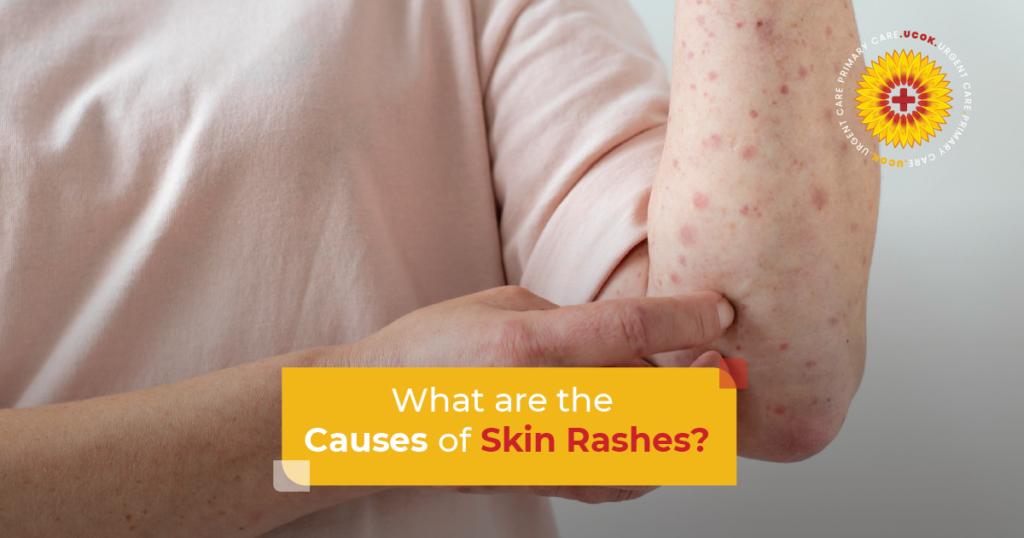 What Are the Causes of Skin Rashes?