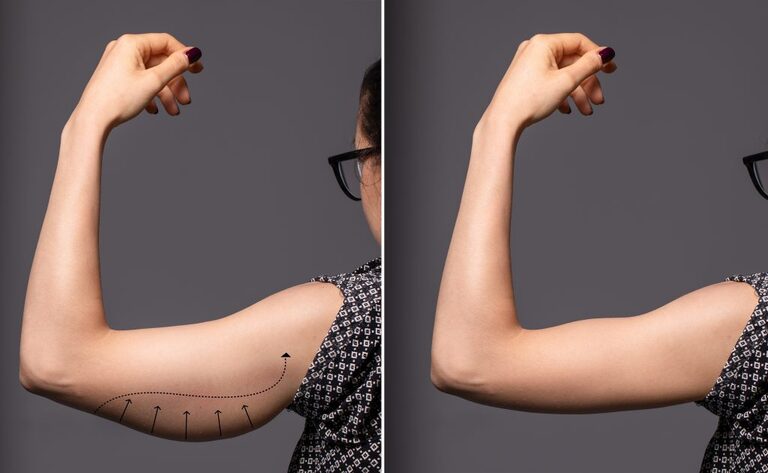 CoolSculpting for Arm Fat: Slim and Tone Your Upper Arms