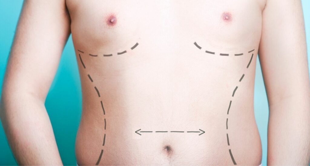 Gynecomastia Surgery in New Jersey: A Guide to Transforming