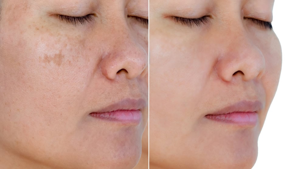 Is Pico Laser the Secret to Youthful Skin?