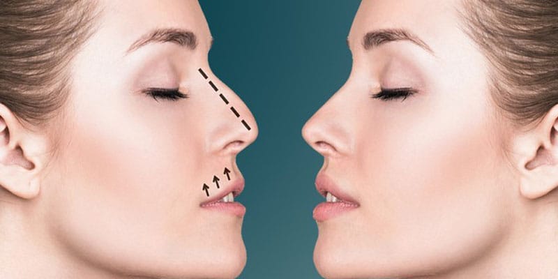 أفضل طرق تجميل الأنف في الرياض بدون جراحة