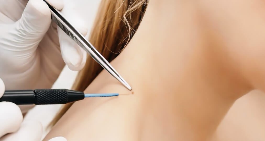 The Price Tag for Wart-Free Skin: How Much Will It Cost?