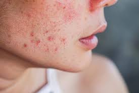 The Long-Term Benefits of Treating Acne Early