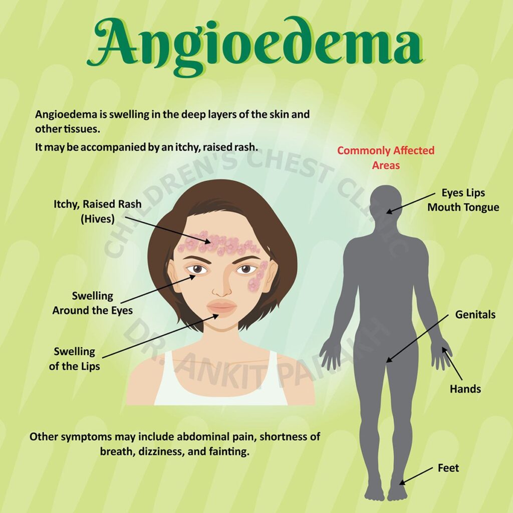 What Should You Do During an Angioedema Attack?