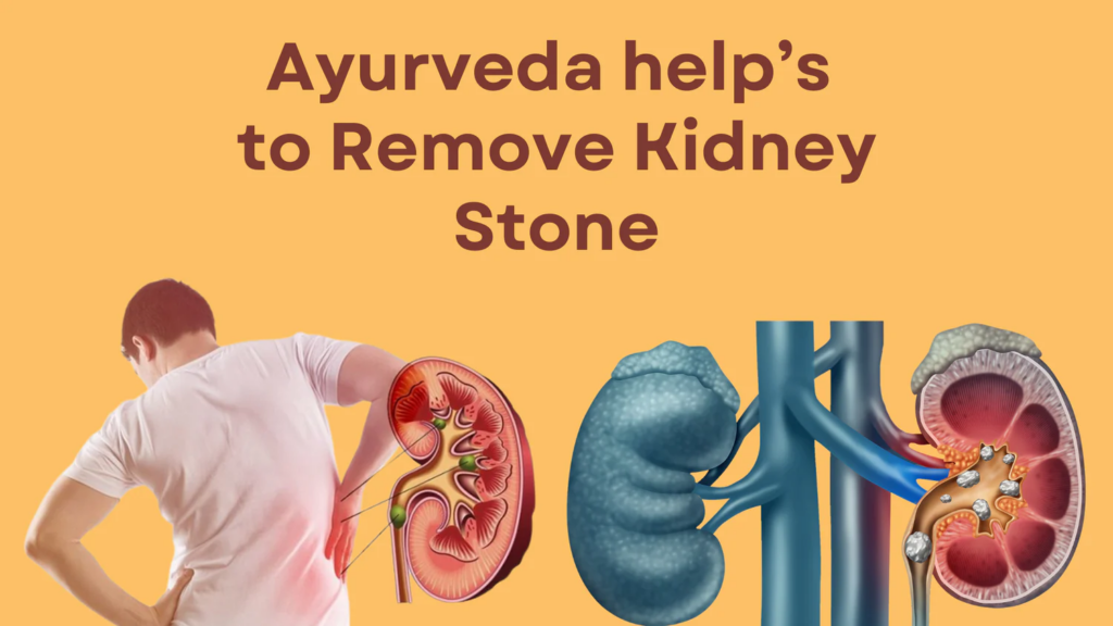 Kidney Stone Ayurvedic Solutions: SL-90 Renal Drop & Stone R