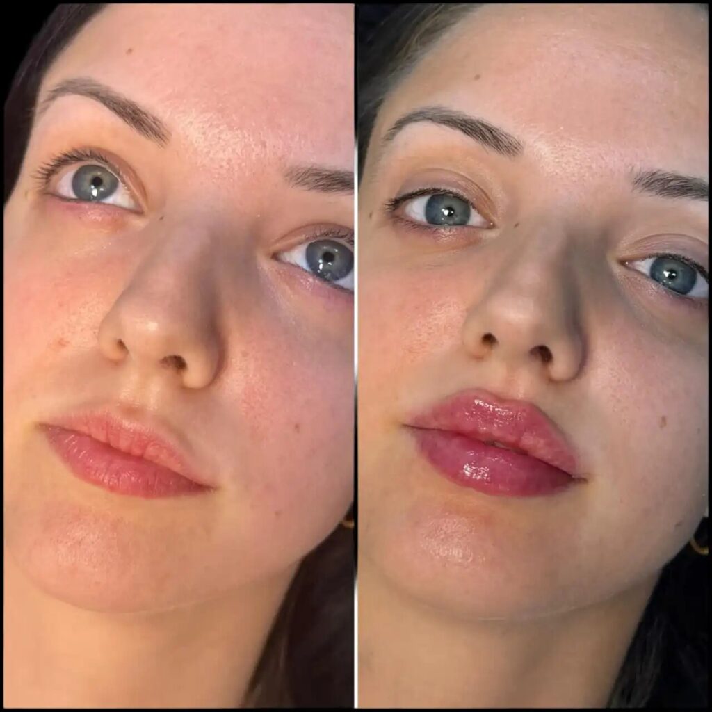 How to Choose the Best Aesthetic Clinic in dubai for Dermal Fillers