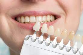 Discover the Impact of Dental Veneers on Your Smile Journey
