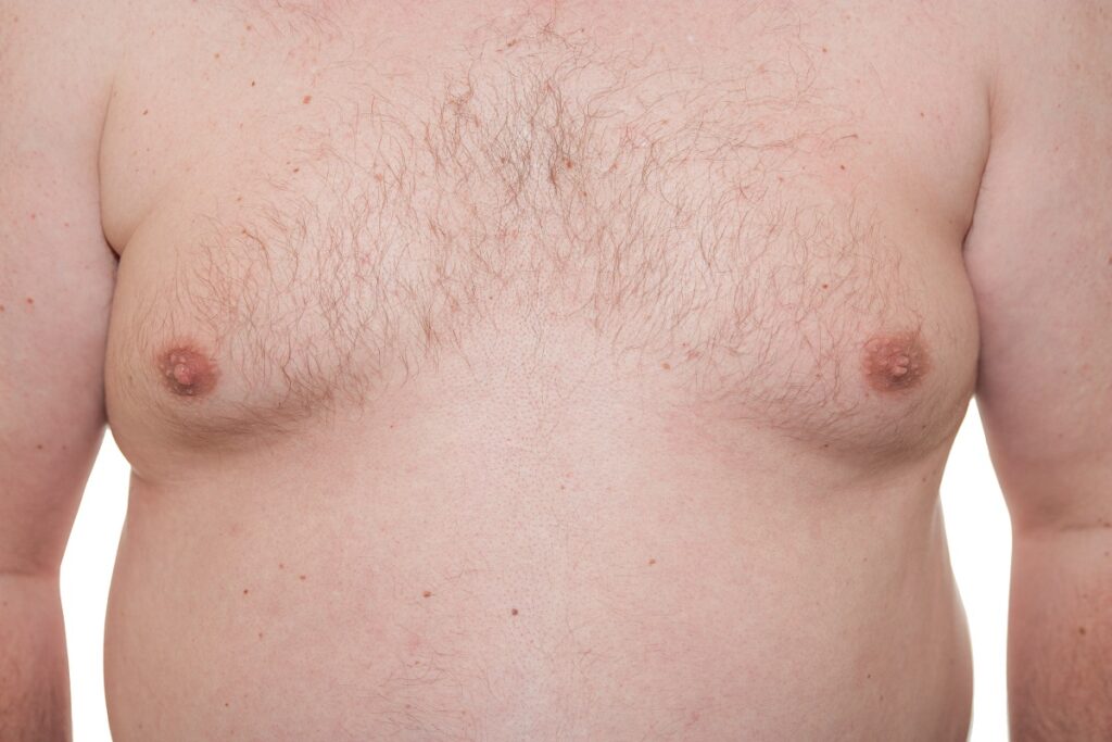 The Best Non-Surgical Treatments for Gynecomastia